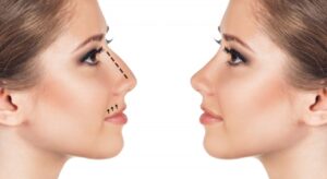 Rinofiller vs Rinoplastica: cosa chiedono davvero i pazienti (e cosa devono sapere i professionisti)