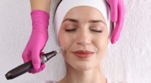 Microneedling: quando la community lo considera davvero utile?